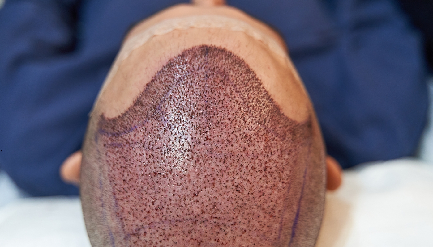 العلاج التجميلي وزراعة الشعر في عيادات شيفون – نتائج طبيعية ومظهر متجدد صورة توضح أحد أطباء عيادات شيفون أثناء إجراء عملية زراعة شعر باستخدام أحدث تقنيات العلاج التجميلي الحديثة في مصر
