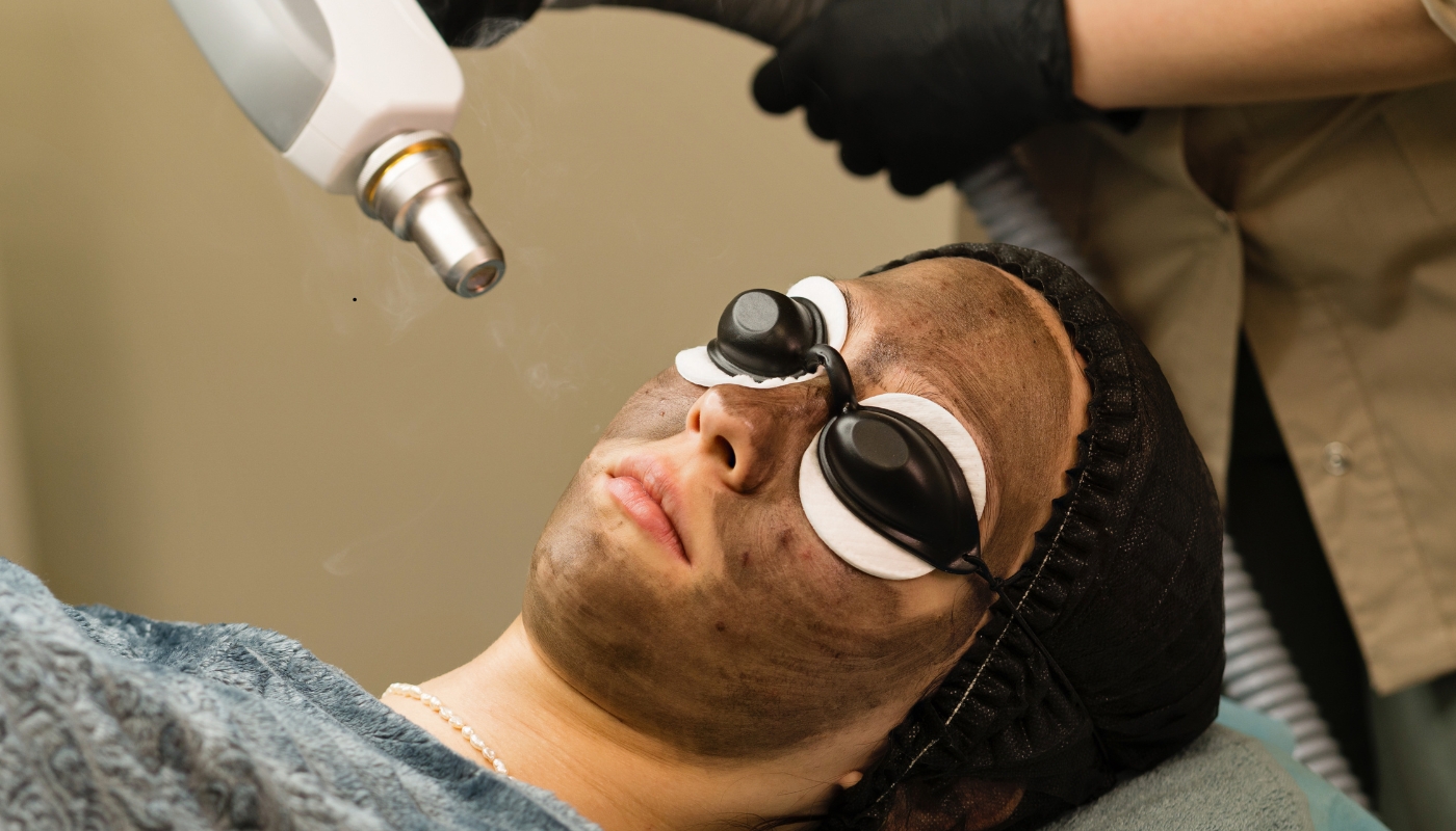 chiffon clinic (1) إزالة التصبغات بالليزر الكربوني في عيادات شيفون للحصول على بشرة ناعمة ومتجانسة بإشراف خبراء الجلدية