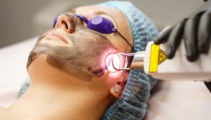 جلسة الليزر الكربوني