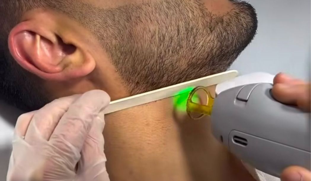 عيادة ليزر للرجال في المهندسين عيادة ليزر للرجال في المهندسين